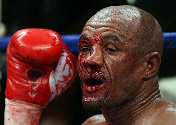 Boxer mit stark blutendem Gesicht